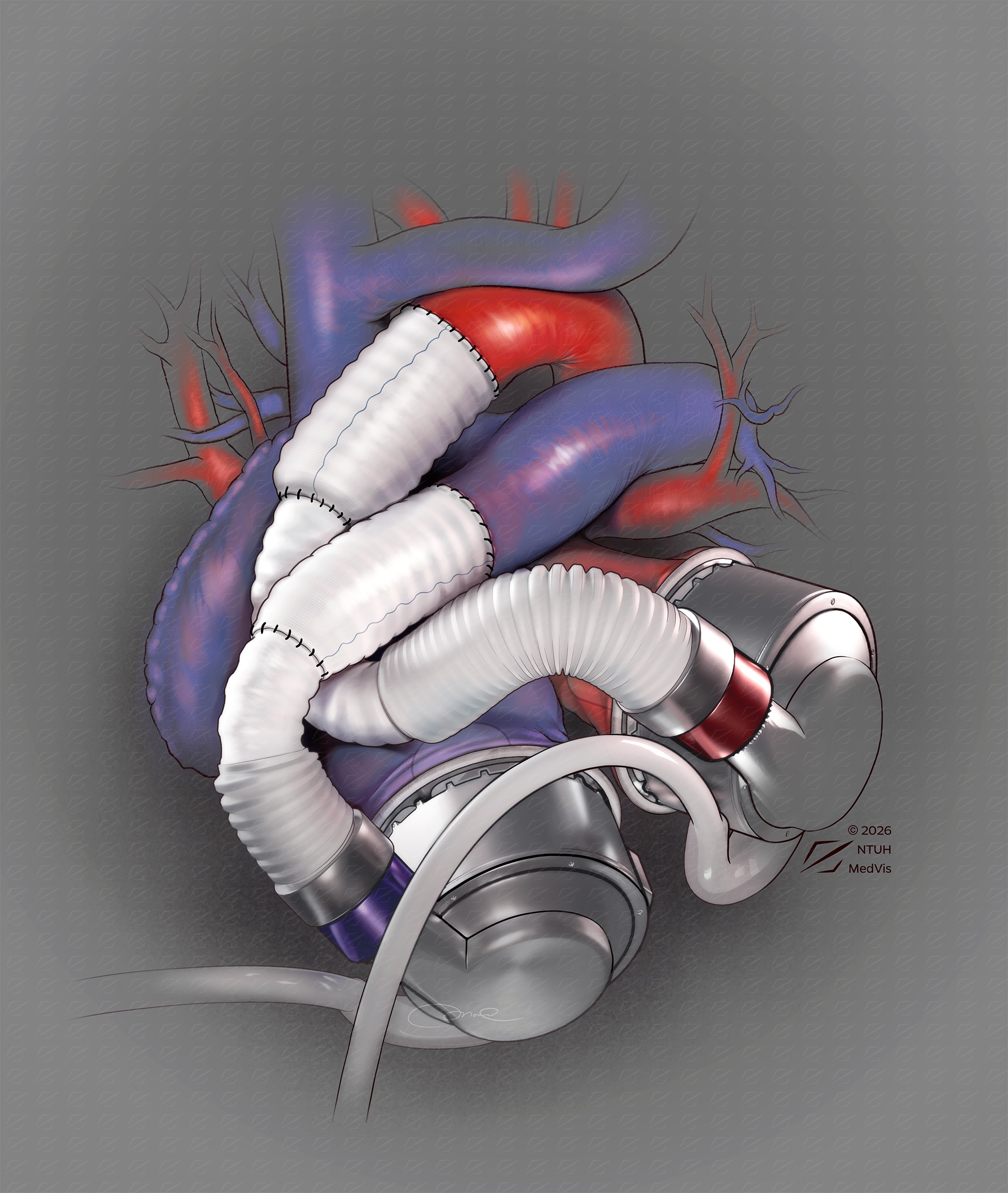Dual HeartMate 3 in total artificial heart configuration